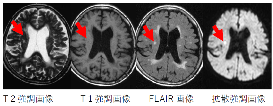 脳卒中を知る！－脳を守るには、時間が最も重要だ！！－ | セラピア